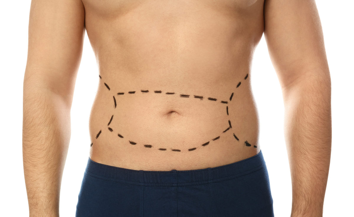 Abdominoplastie masculine