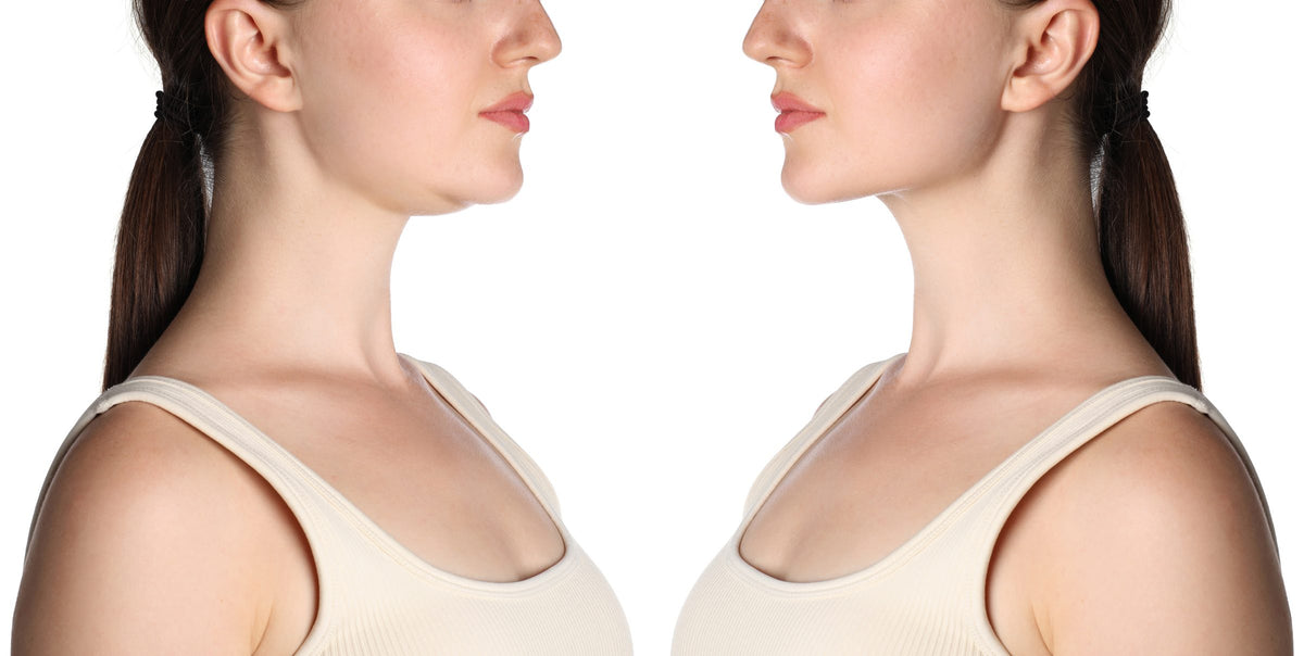 Liposuccion du double menton
