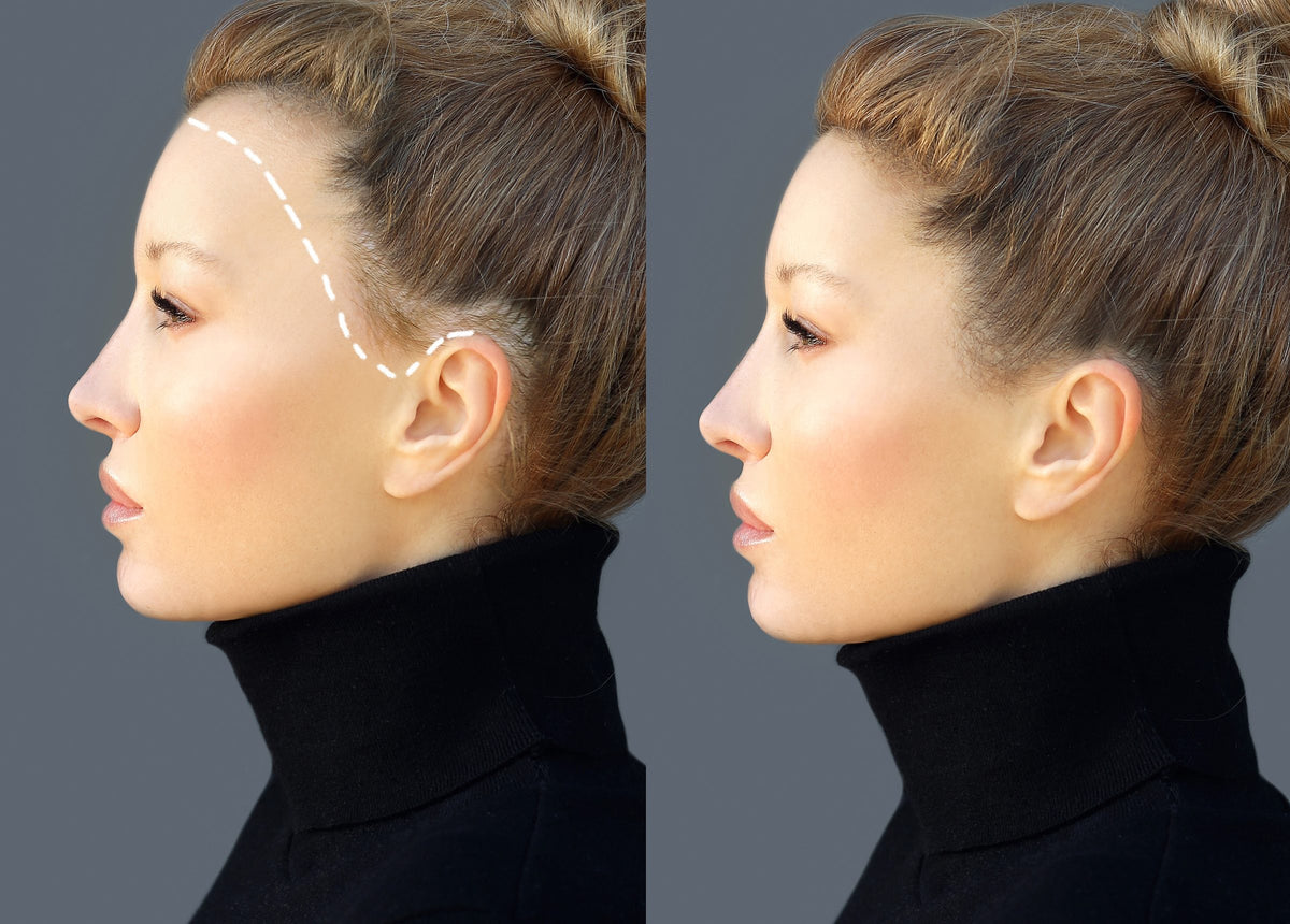 زراعة الشعر المباشرة (DHI)